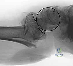 صورة توضيحية لـ تثبيت كسور عظم الكعبرة البعيدة المتناسب مع الشظايا: دليل شامل للمرضى مع الأستاذ الدكتور محمد هطيف