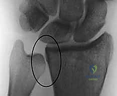 صورة توضيحية لـ تثبيت كسور عظم الكعبرة البعيدة المتناسب مع الشظايا: دليل شامل للمرضى مع الأستاذ الدكتور محمد هطيف