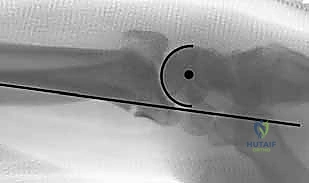 صورة طبية: تثبيت كسور عظم الكعبرة البعيدة المتناسب مع الشظايا: دليل شامل للمرضى مع الأستاذ الدكتور محمد هطيف