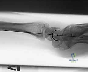 صورة توضيحية لـ تثبيت كسور عظم الكعبرة البعيدة المتناسب مع الشظايا: دليل شامل للمرضى مع الأستاذ الدكتور محمد هطيف