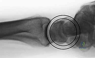 صورة توضيحية لـ تثبيت كسور عظم الكعبرة البعيدة المتناسب مع الشظايا: دليل شامل للمرضى مع الأستاذ الدكتور محمد هطيف