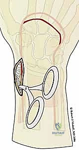 صورة طبية: تثبيت كسور عظم الكعبرة البعيدة المتناسب مع الشظايا: دليل شامل للمرضى مع الأستاذ الدكتور محمد هطيف