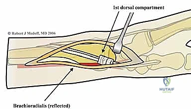 صورة طبية: تثبيت كسور عظم الكعبرة البعيدة المتناسب مع الشظايا: دليل شامل للمرضى مع الأستاذ الدكتور محمد هطيف