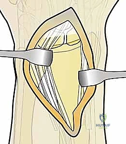 تثبيت كسور عظم الكعبرة البعيدة المتناسب مع الشظايا: دليل شامل للمرضى مع الأستاذ الدكتور محمد هطيف