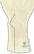 صورة طبية: تثبيت كسور عظم الكعبرة البعيدة المتناسب مع الشظايا: دليل شامل للمرضى مع الأستاذ الدكتور محمد هطيف
