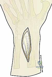 صورة طبية: تثبيت كسور عظم الكعبرة البعيدة المتناسب مع الشظايا: دليل شامل للمرضى مع الأستاذ الدكتور محمد هطيف