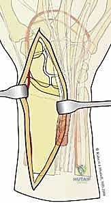 صورة طبية: تثبيت كسور عظم الكعبرة البعيدة المتناسب مع الشظايا: دليل شامل للمرضى مع الأستاذ الدكتور محمد هطيف