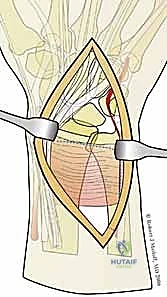 صورة طبية: تثبيت كسور عظم الكعبرة البعيدة المتناسب مع الشظايا: دليل شامل للمرضى مع الأستاذ الدكتور محمد هطيف