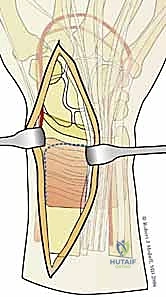 صورة طبية: تثبيت كسور عظم الكعبرة البعيدة المتناسب مع الشظايا: دليل شامل للمرضى مع الأستاذ الدكتور محمد هطيف