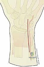 صورة طبية: تثبيت كسور عظم الكعبرة البعيدة المتناسب مع الشظايا: دليل شامل للمرضى مع الأستاذ الدكتور محمد هطيف