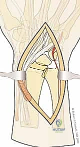 صورة طبية: تثبيت كسور عظم الكعبرة البعيدة المتناسب مع الشظايا: دليل شامل للمرضى مع الأستاذ الدكتور محمد هطيف