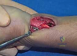 صورة طبية: تثبيت كسور عظم الكعبرة البعيدة المتناسب مع الشظايا: دليل شامل للمرضى مع الأستاذ الدكتور محمد هطيف