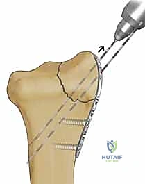 صورة طبية: تثبيت كسور عظم الكعبرة البعيدة المتناسب مع الشظايا: دليل شامل للمرضى مع الأستاذ الدكتور محمد هطيف