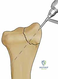 تفاصيل التشريح الدقيق لعظم الكعبرة وتخطيط الجراحة