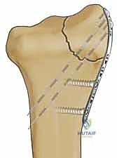 صورة طبية: تثبيت كسور عظم الكعبرة البعيدة المتناسب مع الشظايا: دليل شامل للمرضى مع الأستاذ الدكتور محمد هطيف