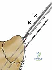 صورة طبية: تثبيت كسور عظم الكعبرة البعيدة المتناسب مع الشظايا: دليل شامل للمرضى مع الأستاذ الدكتور محمد هطيف