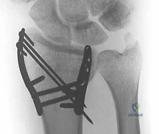 صورة طبية: تثبيت كسور عظم الكعبرة البعيدة المتناسب مع الشظايا: دليل شامل للمرضى مع الأستاذ الدكتور محمد هطيف