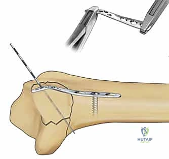 صورة طبية: تثبيت كسور عظم الكعبرة البعيدة المتناسب مع الشظايا: دليل شامل للمرضى مع الأستاذ الدكتور محمد هطيف