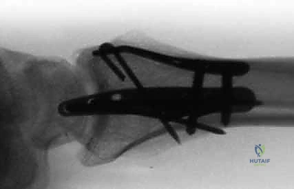 صورة طبية: تثبيت كسور عظم الكعبرة البعيدة المتناسب مع الشظايا: دليل شامل للمرضى مع الأستاذ الدكتور محمد هطيف