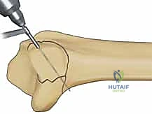 صورة طبية: تثبيت كسور عظم الكعبرة البعيدة المتناسب مع الشظايا: دليل شامل للمرضى مع الأستاذ الدكتور محمد هطيف