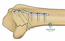 صورة طبية: تثبيت كسور عظم الكعبرة البعيدة المتناسب مع الشظايا: دليل شامل للمرضى مع الأستاذ الدكتور محمد هطيف