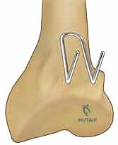 صورة طبية: تثبيت كسور عظم الكعبرة البعيدة المتناسب مع الشظايا: دليل شامل للمرضى مع الأستاذ الدكتور محمد هطيف