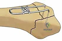 هشاشة العظام كعامل خطر رئيسي لكسور الرسغ