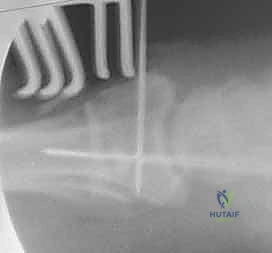 صورة طبية: تثبيت كسور عظم الكعبرة البعيدة المتناسب مع الشظايا: دليل شامل للمرضى مع الأستاذ الدكتور محمد هطيف