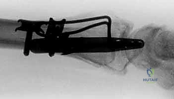 صورة طبية: تثبيت كسور عظم الكعبرة البعيدة المتناسب مع الشظايا: دليل شامل للمرضى مع الأستاذ الدكتور محمد هطيف