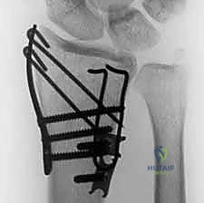 صورة طبية: تثبيت كسور عظم الكعبرة البعيدة المتناسب مع الشظايا: دليل شامل للمرضى مع الأستاذ الدكتور محمد هطيف