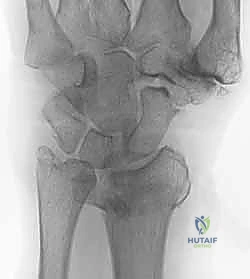 صورة طبية: تثبيت كسور عظم الكعبرة البعيدة المتناسب مع الشظايا: دليل شامل للمرضى مع الأستاذ الدكتور محمد هطيف