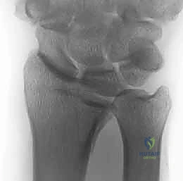 صورة طبية: تثبيت كسور عظم الكعبرة البعيدة المتناسب مع الشظايا: دليل شامل للمرضى مع الأستاذ الدكتور محمد هطيف