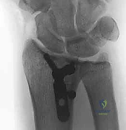 صورة طبية: تثبيت كسور عظم الكعبرة البعيدة المتناسب مع الشظايا: دليل شامل للمرضى مع الأستاذ الدكتور محمد هطيف