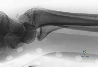 صورة طبية: تثبيت كسور عظم الكعبرة البعيدة المتناسب مع الشظايا: دليل شامل للمرضى مع الأستاذ الدكتور محمد هطيف