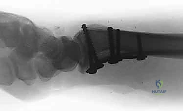 صورة طبية: تثبيت كسور عظم الكعبرة البعيدة المتناسب مع الشظايا: دليل شامل للمرضى مع الأستاذ الدكتور محمد هطيف