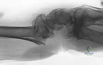 صورة طبية: تثبيت كسور عظم الكعبرة البعيدة المتناسب مع الشظايا: دليل شامل للمرضى مع الأستاذ الدكتور محمد هطيف