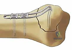 صورة طبية: تثبيت كسور عظم الكعبرة البعيدة المتناسب مع الشظايا: دليل شامل للمرضى مع الأستاذ الدكتور محمد هطيف