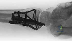 صورة طبية: تثبيت كسور عظم الكعبرة البعيدة المتناسب مع الشظايا: دليل شامل للمرضى مع الأستاذ الدكتور محمد هطيف