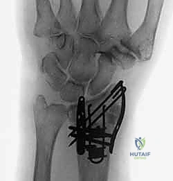 تشوه الرسغ والأعراض السريرية للكسر