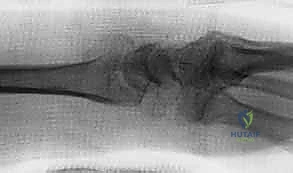 صورة طبية: تثبيت كسور عظم الكعبرة البعيدة المتناسب مع الشظايا: دليل شامل للمرضى مع الأستاذ الدكتور محمد هطيف