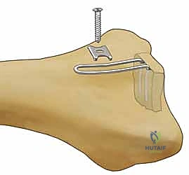 صورة طبية: تثبيت كسور عظم الكعبرة البعيدة المتناسب مع الشظايا: دليل شامل للمرضى مع الأستاذ الدكتور محمد هطيف
