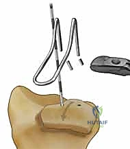 صورة طبية: تثبيت كسور عظم الكعبرة البعيدة المتناسب مع الشظايا: دليل شامل للمرضى مع الأستاذ الدكتور محمد هطيف
