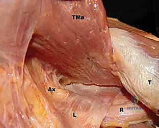 Latissimus Dorsi Transfer for Irreparable Posterosuperior Rotator Cuff Tears: An Intraoperative Masterclass