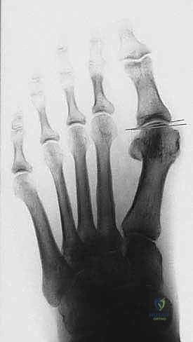 مقدمة جراحة عظمة إبهام القدم الأروح