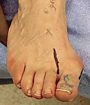 تأثير الورم الملتهب على ميكانيكية المشي