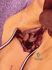 إجراء القطع العظمي بدقة متناهية