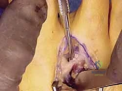 جراحة عظمة إبهام القدم الأروح بتقنية ماو: حل متقدم للورم الملتهب مع الأستاذ الدكتور محمد هطيف