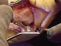 التشريح المعقد للقدم وإبهام القدم الأروح