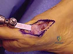 مرحلة التعافي والتأهيل بعد الجراحة