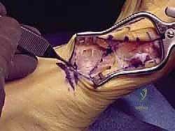 التشخيص الدقيق بالأشعة السينية لتقييم زوايا القدم